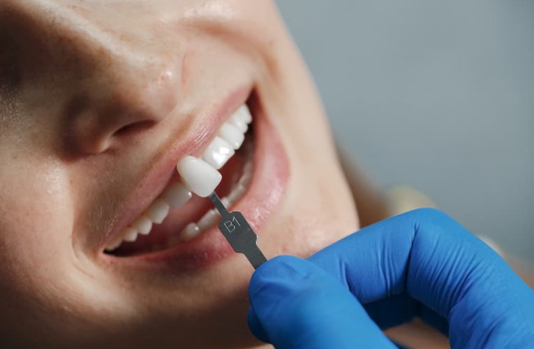 Las 10 preguntas más frecuentes sobre implantes dentales